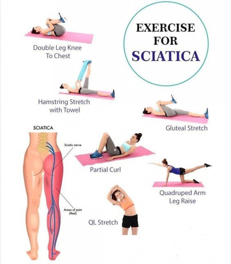 Sciatica: What It Is and How to Treat It